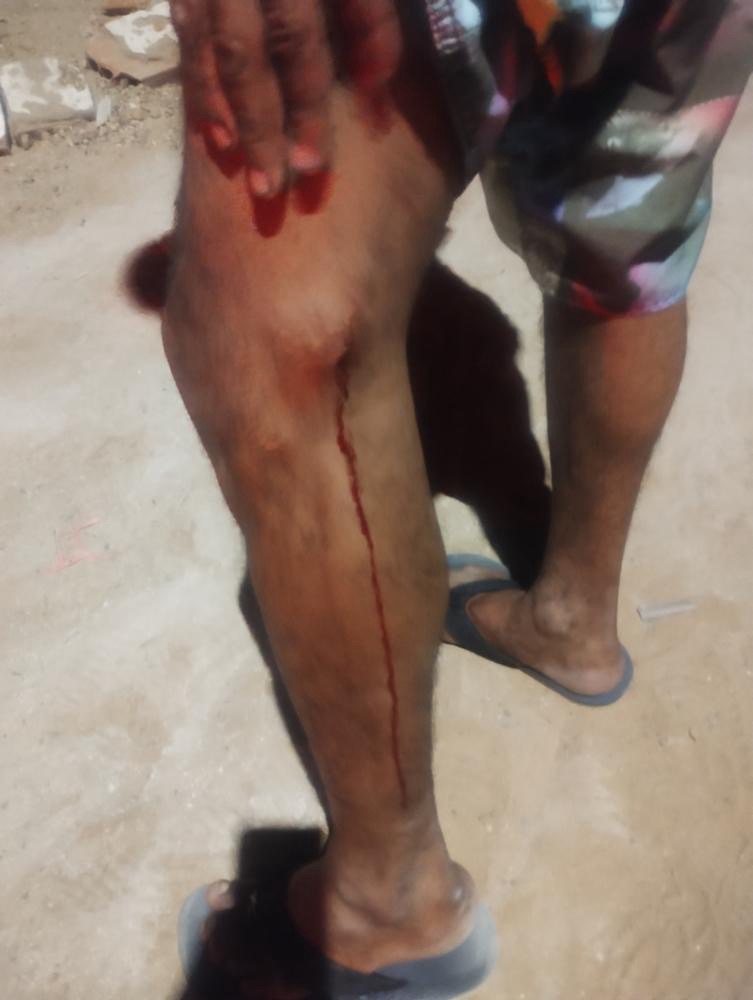 Homem leva tiro acidental na perna em Posse-GO; polícia investiga