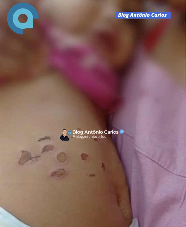 Bebê de 10 meses sofre queimaduras possivelmente causadas por cigarros em Vila Boa-GO